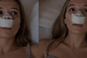 Una donna fa la rinoplastica… per far ereditare il naso ai figli. Lamarck applaude?