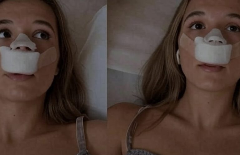 rinoplastica-tiktoker